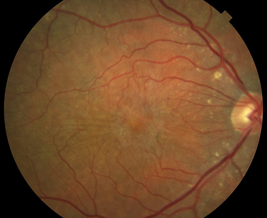 Membrana epirretiniana macular