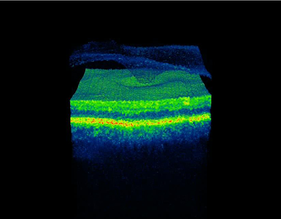 Sindrome de traccio macular