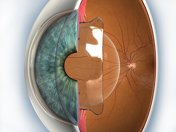 Visian-ICL (CIRUG REFRACTIVA LENT FAQUICA)